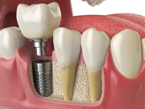 6 Types Of Implant Crowns For Your Teeth