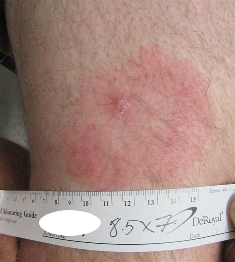 Tick Bites How To Prevent Lyme Disease Allina Health, 55% OFF