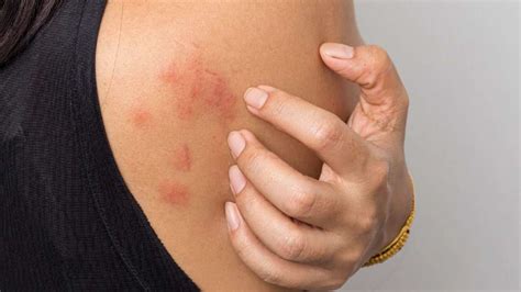 Stress Rash: Spotting & Treating It (Photo Examples)