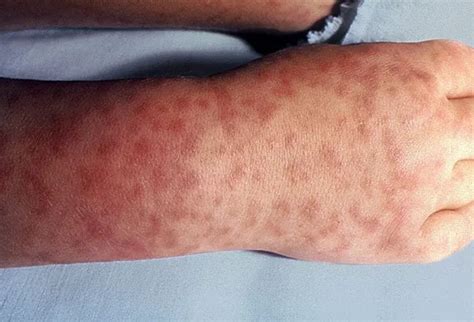 Rocky Mountain Spotted Fever Rash Pictures - PictureMeta