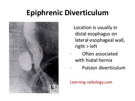 Epiphrenic diverticulum