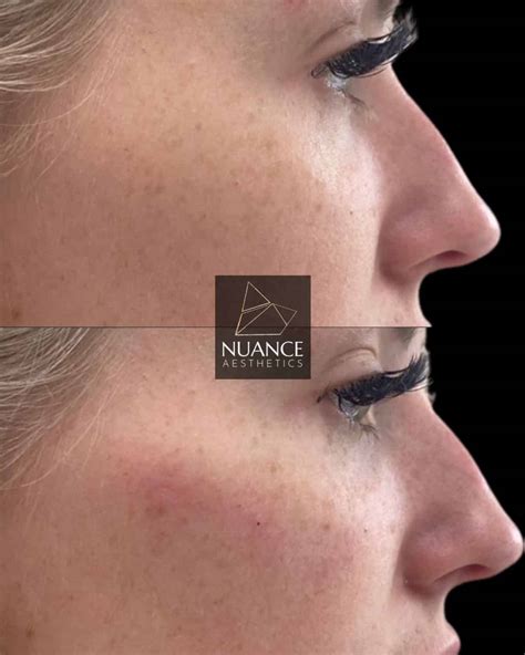 Cheek Fillers - Nuance