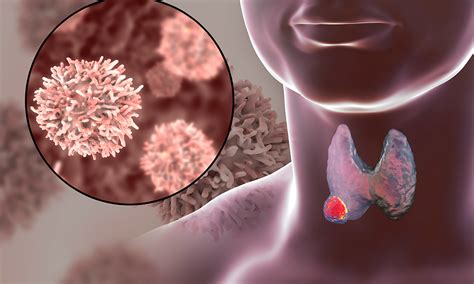 Thyroid Cancer Symptoms and Signs