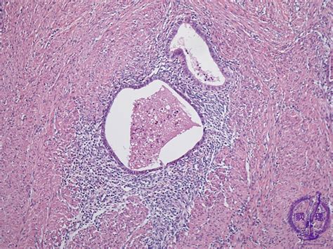 15.Female genital organs (2) Adenomyosis|Pathology Core Pictures