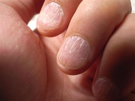 What these common nail problems could be telling you about your health