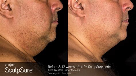 Double Chin Treatments - Kirkland, WA: Sound Medical Weight Loss ...