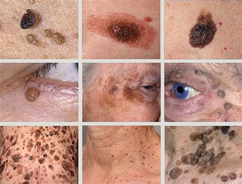 Why Seborrhoeic Warts Require Consultation | Skin Care Network