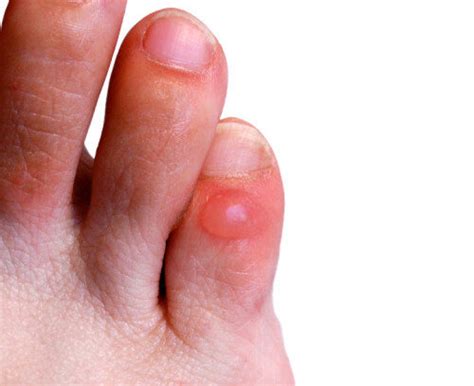 How to avoid Blisters on your Feet — River Podiatry I The Best Foot and ...