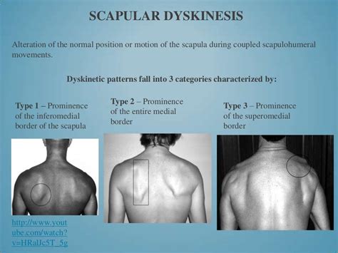 S.I.C.K. Scapula with Clavicle Fractures Case Study Presentation (201…