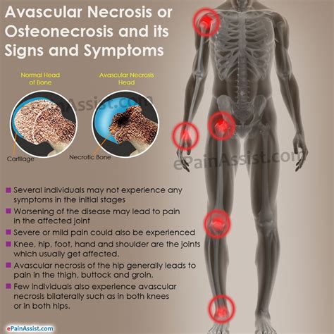 Necrose avascular (osteonecrose): sintomas, tratamento e muito mais - Artrite 2024