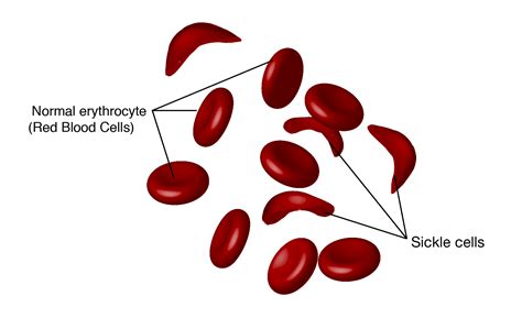 Sickle Cell Anemia