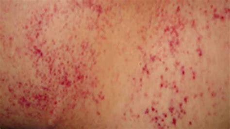 Pinpoint Red Dots On Skin This Could Be Petechiae - vrogue.co
