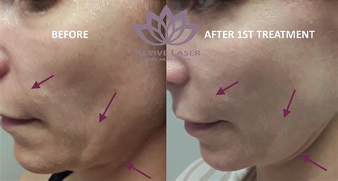 Laser Skin Tightening before and after - Revive Laser and Skin Clinic