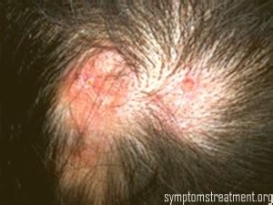 Discoid Lupus- Pictures, Symptoms, Treatment, Photos