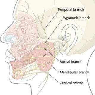 Split hypoglossal nerve to facial nerve transfer. Either superior or ...