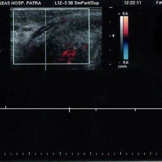 (PDF) Penile Mondor's disease: A case report