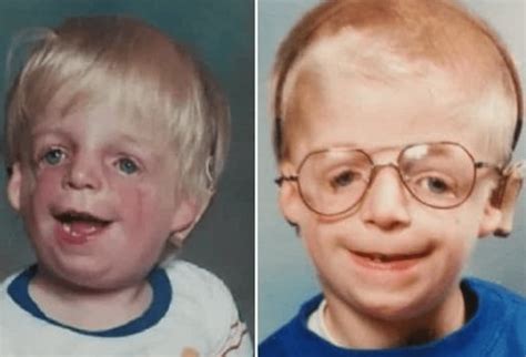 Baby Born With A Deformed Face Was Abandoned At Birth, But Look At Him Now, 30 Years Later ...