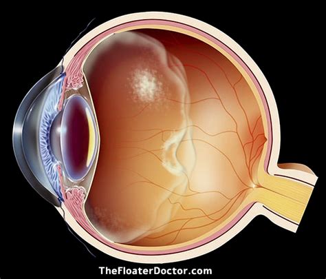 VITREOUS EYE FLOATERS | The Floater Doctor