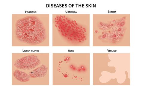 Skin Infections: Types, Symptoms, Treatment & Prevention (2022)