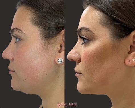 Kybella Fat Dissolving - Before and After Results at Skinly