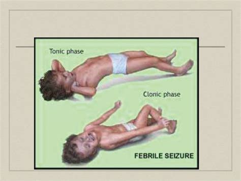 Febrile Seizures in Children | Ipoh Echo