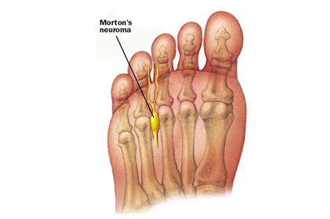 Morton’s Neuroma London UK - Foot Surgery London