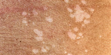 psoriasis white spots | vanallelog1974's Ownd