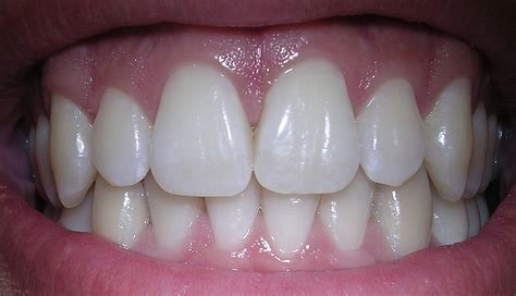 Tooth - Simple English Wikipedia, the free encyclopedia