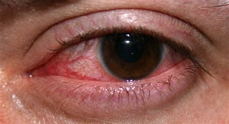 Eye Infections/Conditions :: Eye Health Central