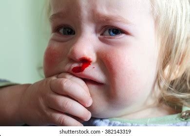 470 Nose Bleed In Children Images, Stock Photos & Vectors | Shutterstock