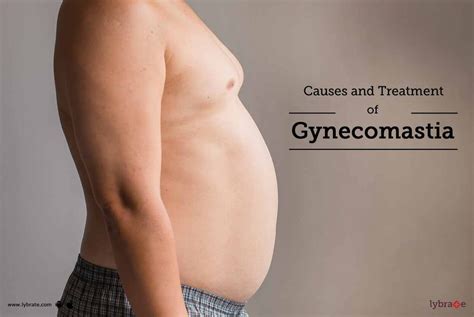 Causes and Treatment of Gynecomastia - By Dr. Deepak Khatri | Lybrate