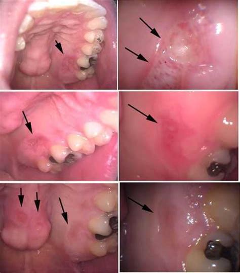 Photos of chapped lips herpes canker sores