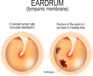 Ear Drum Perforation Surgery