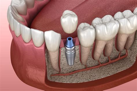 ¿En qué consiste la osteointegración de los implantes dentales?