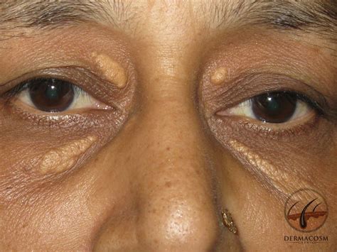 What is xanthelasma? - dermacosm