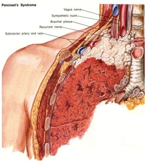 Pancoast Tumor - Physiopedia