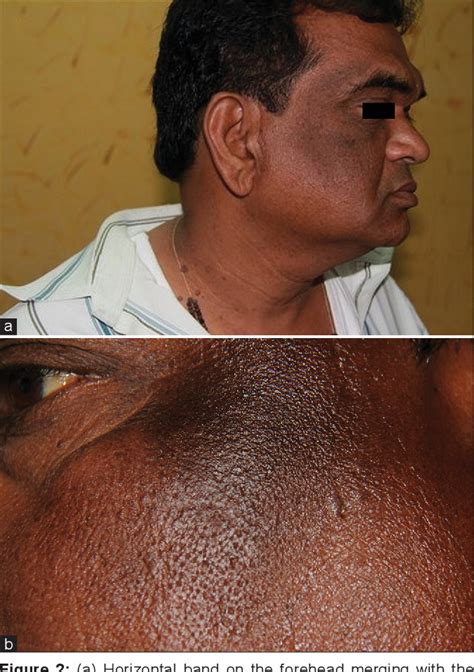 Figure 2 from A descriptive study of facial acanthosis nigricans and ...