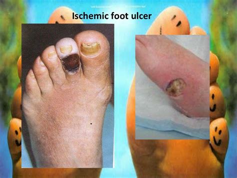 Diabetic foot + gangrene