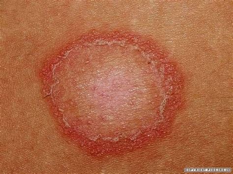 Tinea corporis, cruris, and incognito | Primary Care Dermatology Society | UK | Tinea corporis ...