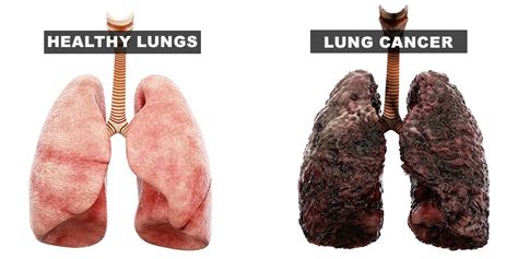 Cigarettes Before And After Lungs