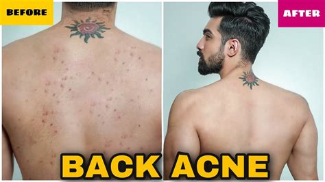 Get How To Get Rid Of Back Acne Scars Naturally Pics - Acne problems