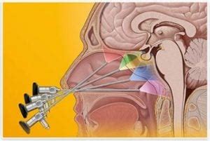 Endoscopic Skull Base Surgery Tampa FL, Nasal & Sinus Services