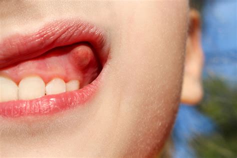 How To Reduce Swelling Of The Gums » Preferenceweather