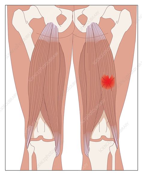 Hamstring muscle injury, artwork - Stock Image - C009/0514 - Science ...