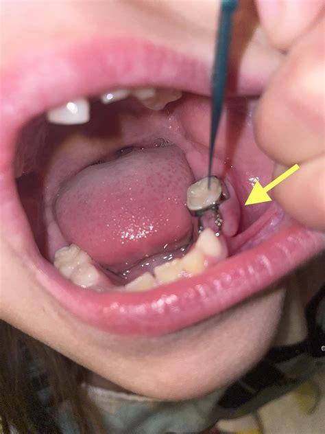 7yr old had tooth pulled, dentist put a spacer in; 2 months later, this occurred. Details in ...