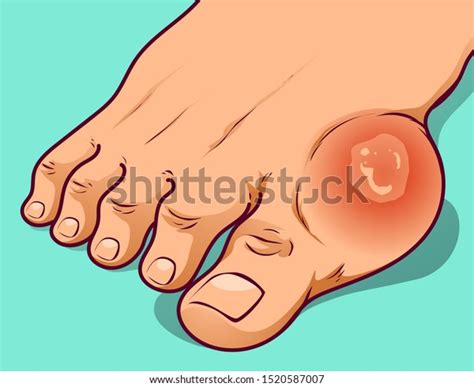 Foot Gout Beforeafter Vector Illustration Stock Vector (Royalty Free) 1520587007