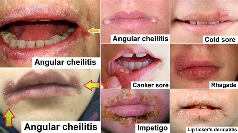 What Is Angular Cheilitis - vrogue.co