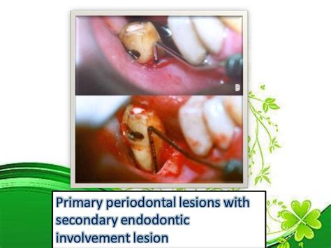 Endo perio lesions