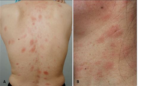 Figure 1 from Generalized Eczema-like Eruption in a Patient Treated ...