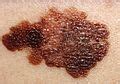 Category:Superficial spreading melanoma - Wikimedia Commons